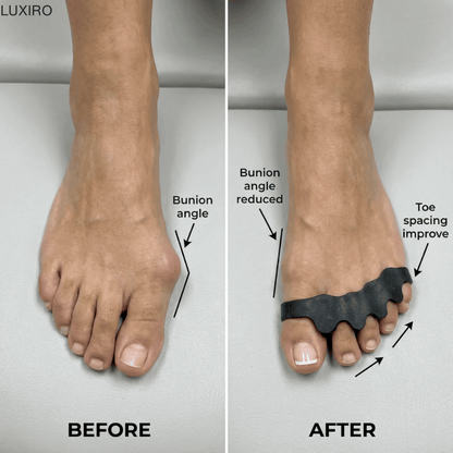Finally, Relief for Bunion Pain—Without Surgery