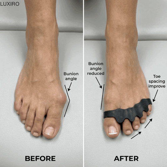 Finally, Relief for Bunion Pain—Without Surgery